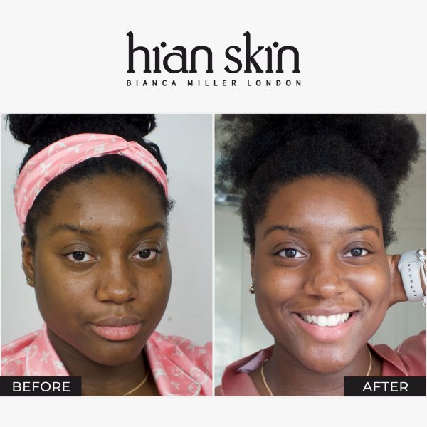 Hian Skin Customer Progress Pictures